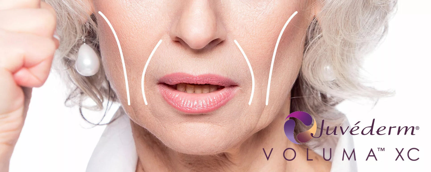 Juvederm Voluma