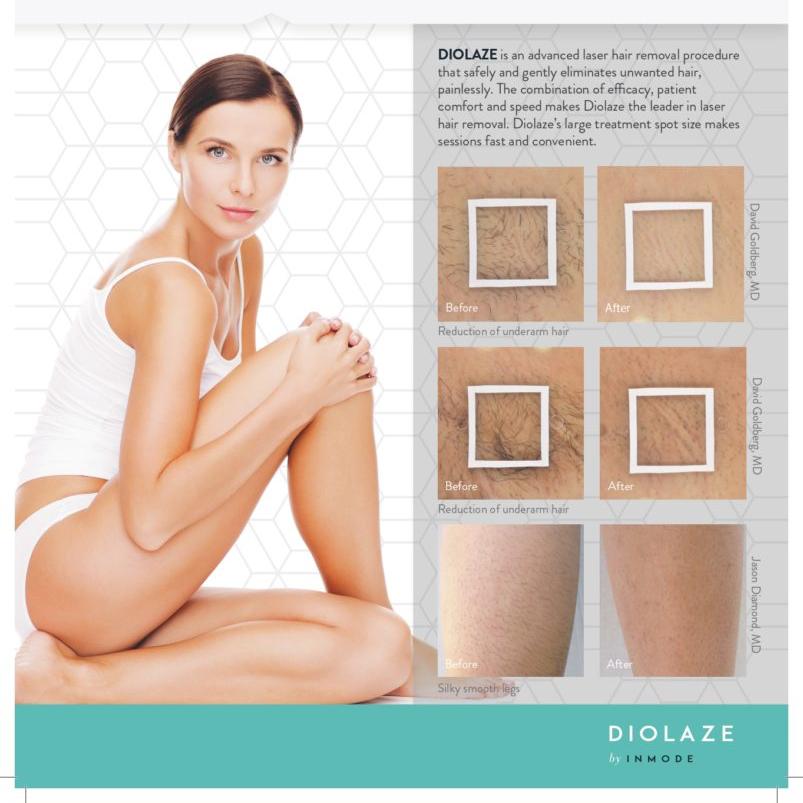 Diolaze Laser Hair Removal (Bikini)  Series of 6 Treatments - Save $180