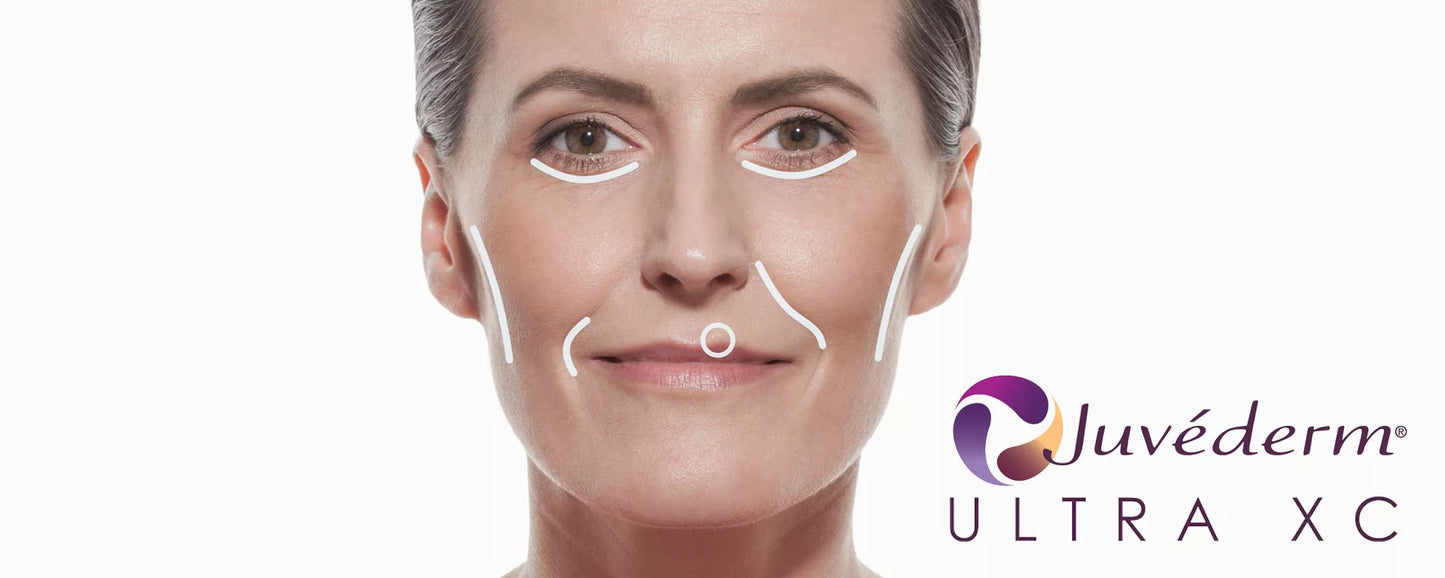 Juvederm Ultra