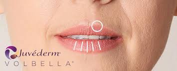 Juvederm Volbella