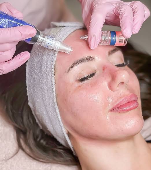 SkinPen Microneedling